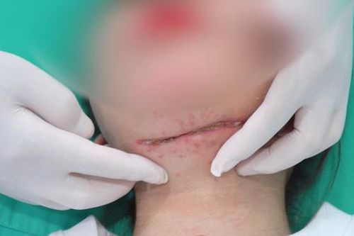 Cô gái nhập viện với vết cắt dài trên cổ sau tiêm tan mỡ nọng cằm