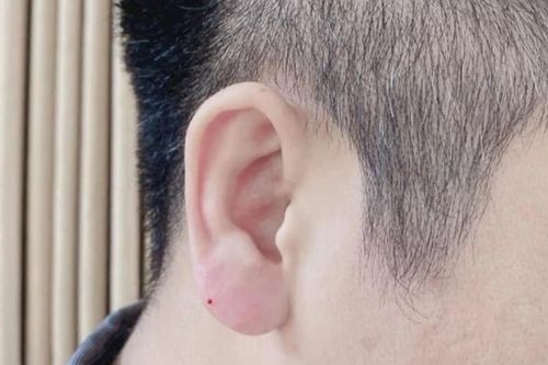 Lạ lùng trào lưu đàn ông đua nhau đi tiêm tai 'Phật Di Lặc'
