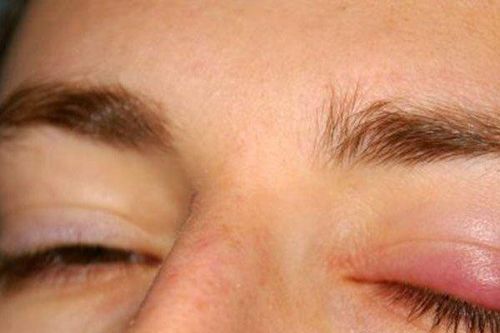 Ngứa mí mắt nhiều ngày, người phụ nữ không ngờ bị ung thư