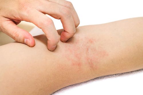 Nhiều 'cựu' F0 bị viêm da, mẩn ngứa vì kiêng tắm quá lâu