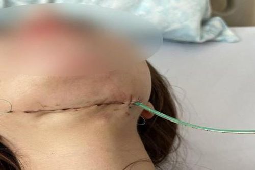 Trải lòng của cô gái 25 tuổi bị hoại tử nặng vùng cổ sau khi tiêm thuốc tan mỡ nọng cằm: 'Có lúc em không muốn sống nữa!'