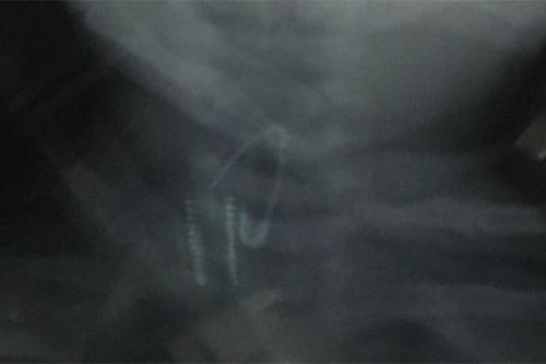 Gắp thành công kim băng mắc ở thực quản cho trẻ 18 tháng tuổi