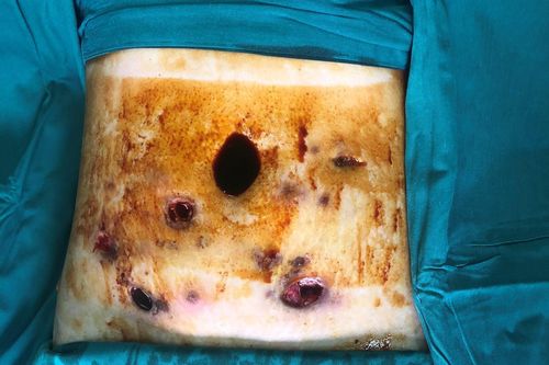 Quý bà thủng hàng chục lỗ trên cơ thể sau tiêm chất tan mỡ để có 'body' đẹp