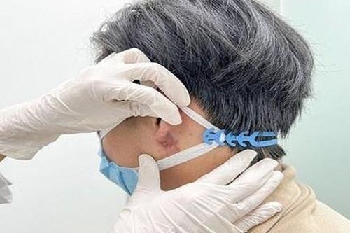 Hiểm họa từ trào lưu nam giới tạo tai Phật bằng tiêm filler