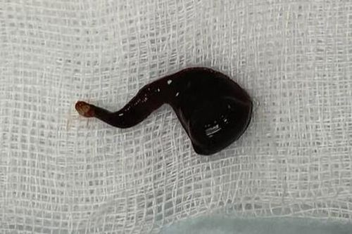 Đỉa 5cm 'làm tổ' trong mũi nam thanh niên gần cả tháng