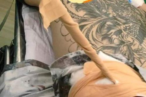 Khánh Hòa: Cứu sống nam thanh niên bị thanh kiếm đâm xuyên thắt lưng