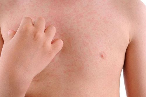Bé trai bị tổn thương da nghiêm trọng sau khi khỏi Covid-19