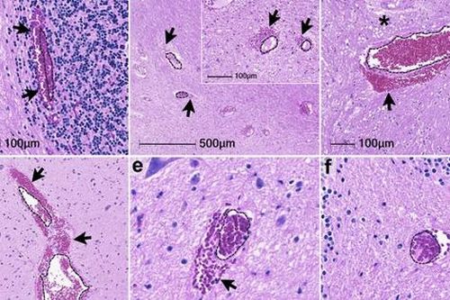 COVID-19 có thể gây viêm và chảy máu não