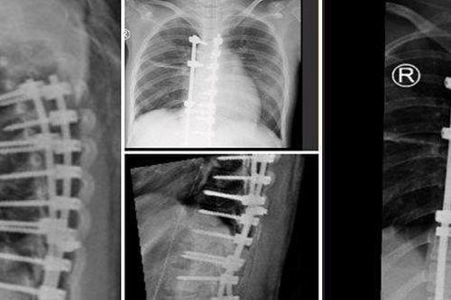 Bé gái 11 tuổi bị chứng lưng cong nguy hiểm