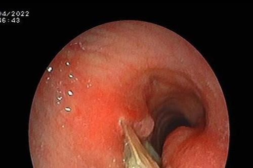 Ho kéo dài do dị vật đường thở