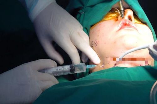 Tiêm chất tan mỡ thon gọn 'body' hiểm họa khó lường
