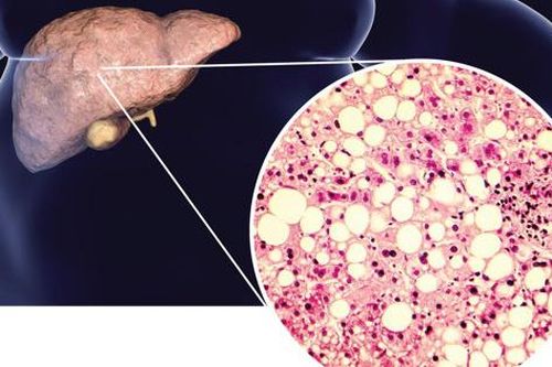 Liệu pháp mới có thể giúp điều trị bệnh gan nhiễm mỡ không do rượu