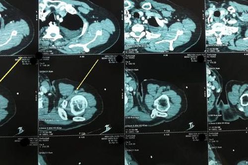 Khánh Hòa: Cứu người tắc động mạch tay trái vì cục máu đông