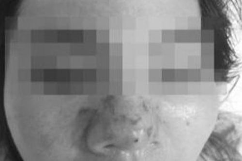 Hỏng cả mặt, mũi vì tiêm thử filler