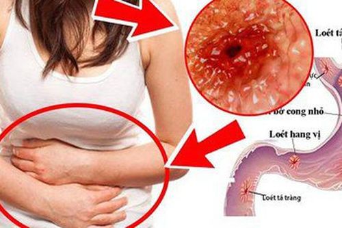 Bé gái bị xuất huyết dạ dày trên nền COVID-19, chuyên gia khuyến cáo dấu hiệu bệnh tuyệt đối không được bỏ qua!