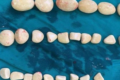 Kinh hãi 'ổ sỏi' lấp đầy trong bàng quang nam bệnh nhân