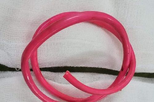 Phát hiện 30cm dây điện trong bàng quang một người đàn ông