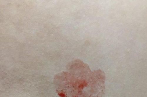 Bé gái 10 tuổi đột nhiên đổ mồ hôi máu