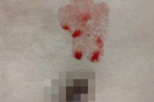 Bé gái chảy mồ hôi máu