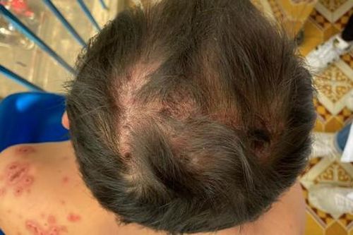 TP.HCM: Bệnh nhân rụng tóc, lở loét toàn thân vì bệnh Rowell rất hiếm gặp