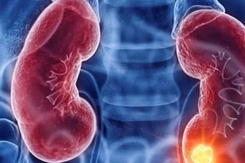 Liệu pháp kết hợp thuốc mới giúp tăng tuổi thọ ở bệnh nhân ung thư thận
