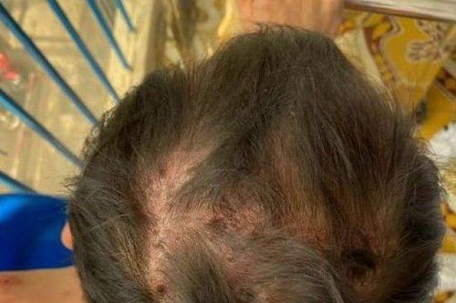 Người đàn ông lở loét khắp người vì căn bệnh cả thế giới mới tìm ra 95 ca