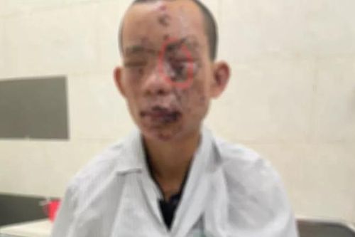 Dùng điện thoại khi đang sạc pin, thanh niên bị cháy sém toàn thân