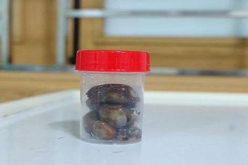 Nhập viện sau thời gian dài dùng thuốc nam trị sỏi thận