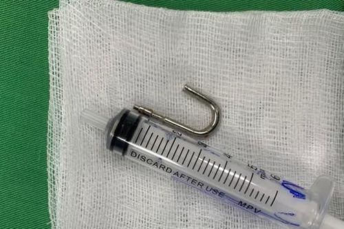 Móc sắt rơi khỏi ổ khóa, 'tuột' vào bụng bé 20 tháng tuổi