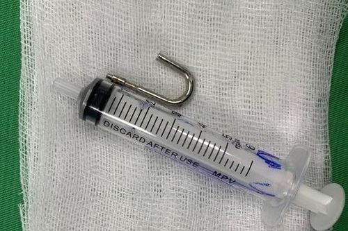 Nghẹt thở gắp móc sắt dài 3cm ra khỏi bụng bé 20 tháng tuổi