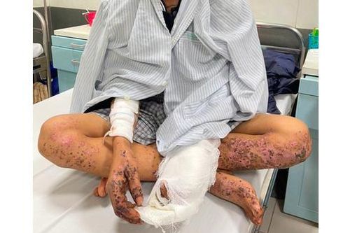 Người đàn ông bị cháy xạm toàn thân khi dùng điện thoại khi đang sạc