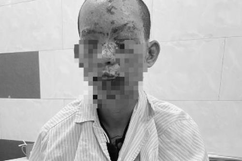 Mất thị lực, cháy sém toàn thân do dùng điện thoại đang sạc