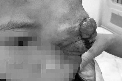 Khối u lớn ở mắt khiến cậu bé dân tộc Thái bị biến dạng cả mặt