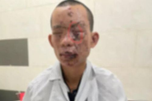 Vừa chơi điện thoại vừa sạc khiến vật phát nổ, nam thanh niên phải trả giá quá đắt khi mới 23 tuổi