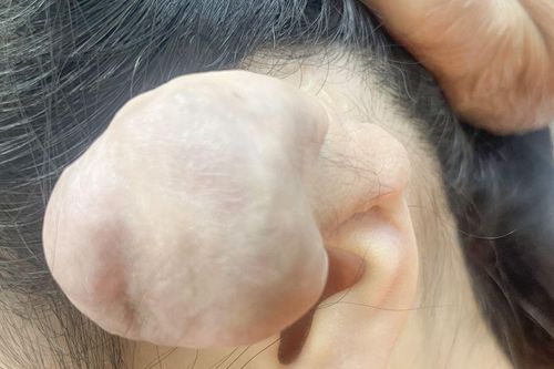Xỏ khuyên, bấm nhiều lỗ trên vành tai dễ dẫn đến nhiều hệ lụy