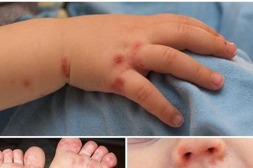 Cứu sống bé gái mắc tay chân miệng nguy kịch