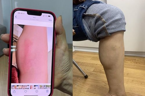 Chi 60 triệu tiêm 'collagen tươi' để làm thẳng chân, bắp chân người phụ nữ biến thành ổ áp xe