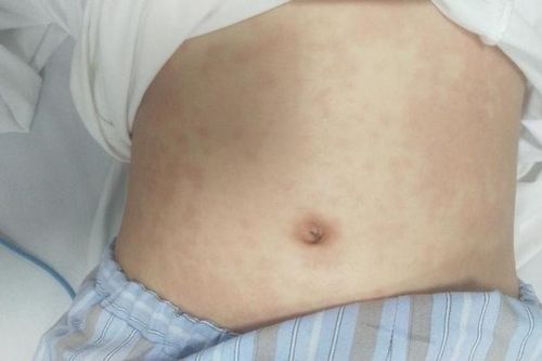 Bé gái nguy kịch sau 2 tuần khỏi Covid-19