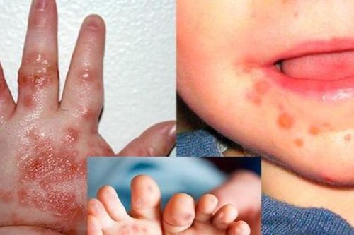 Bệnh nhi mắc tay chân miệng tại TP HCM còn tăng cao