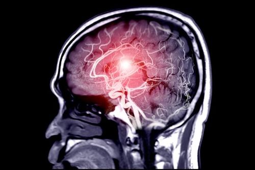 Phương pháp mới có thể cứu người bị đột quỵ