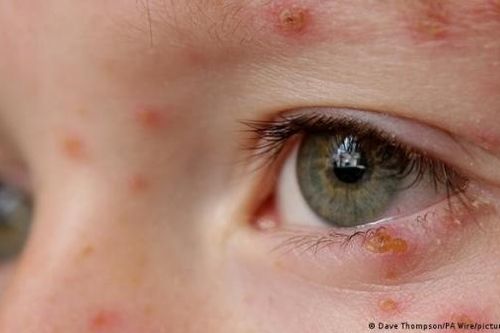 Khi virus Herpes 'thức giấc'