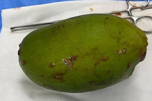 Người đàn ông nhét cả trái xoài vào hậu môn để thử 'cảm giác lạ'