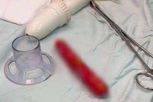 Chàng trai bị kẹt cây xúc xích ở hậu môn
