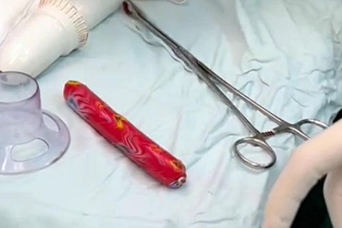 Thanh niên bị kẹt cây xúc xích loại to trong hậu môn vì muốn thử 'cảm giác lạ'
