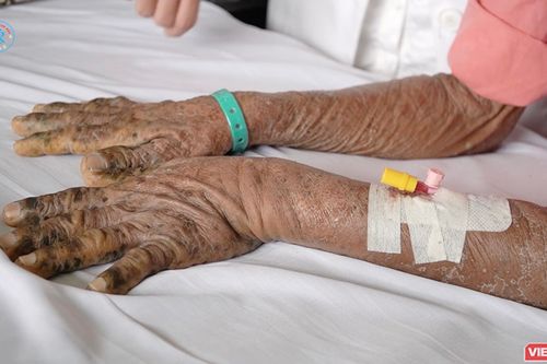 Bác sĩ BV Chợ Rẫy cảnh báo: Mất hàng trăm triệu đồng vì nhiễm độc thuốc nam