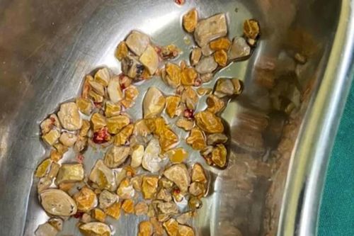 Đau bụng nhiều tháng, người đàn ông nhập viện và được phẫu thuật lấy ra 'cả rổ' sỏi thận