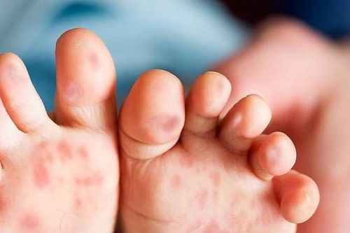 Virus gây tay chân miệng có thể tồn tại trong phân vài tháng