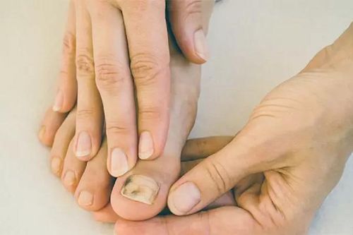 Phát hiện ung thư nhờ đốm lạ ở ngón chân
