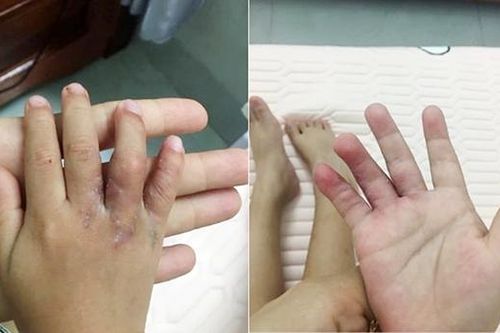 Đà Nẵng: Mổ tách thành công hai bàn tay dính ngón cho cháu bé 19 tháng tuổi