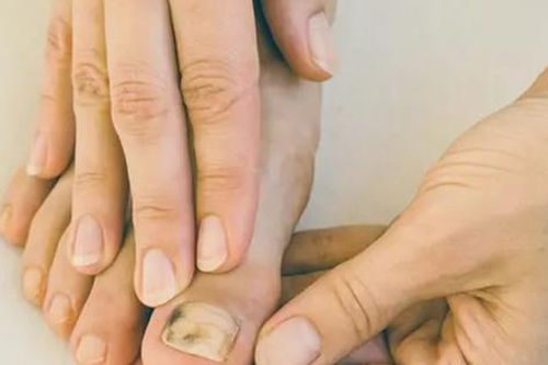 Phát hiện mắc ung thư nhờ điểm lạ ở ngón chân, chuyên gia cho biết người phụ nữ này 'thật may mắn', dù đó là khối u ác tính